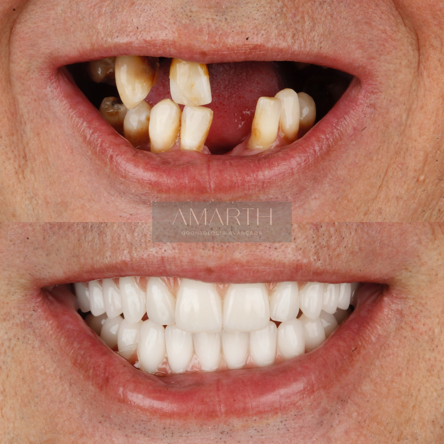 Dentista em Mogi Mirim - Amarth Odontologia - Implante, lentes de contato, facetas, protese, aparelho dentário em Mogi Mirim